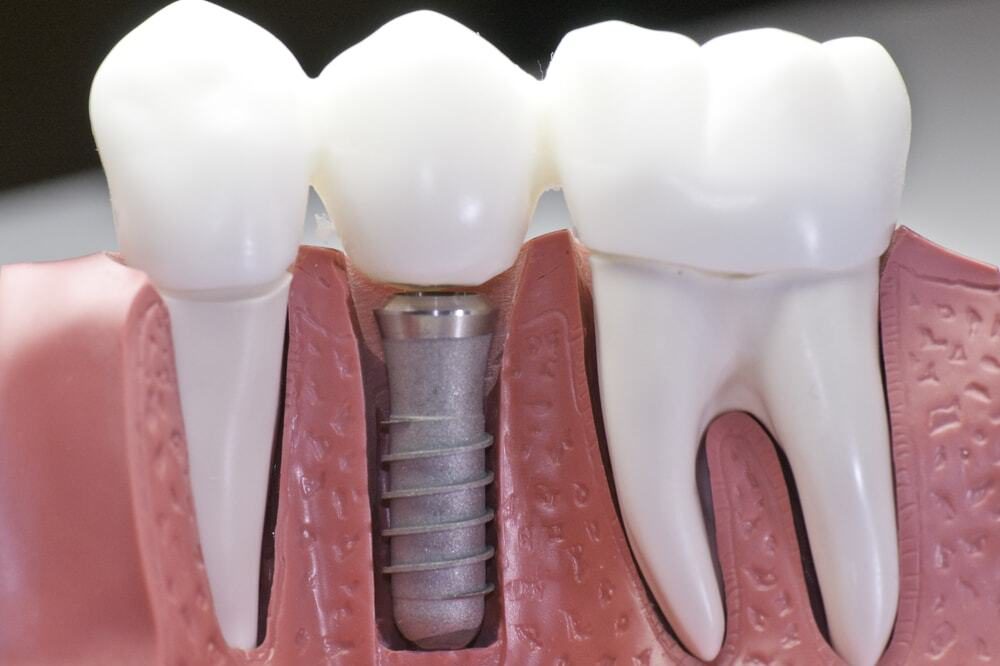 Dental Implant