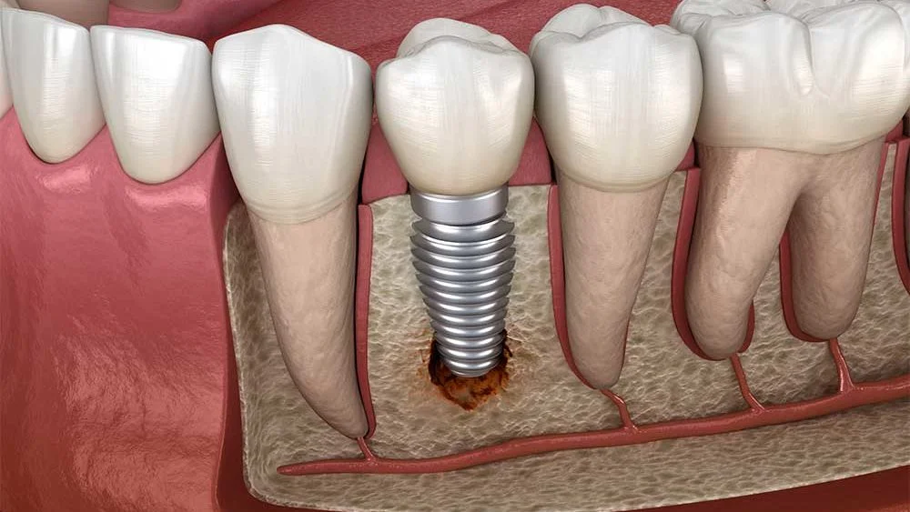 Dental Implant