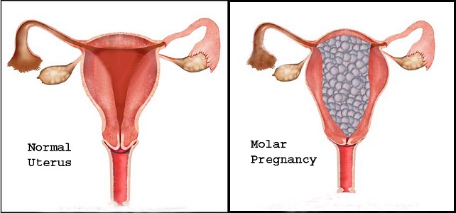 Molar Pregnancy Treatment