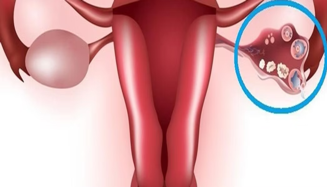 Molar Pregnancy Treatment