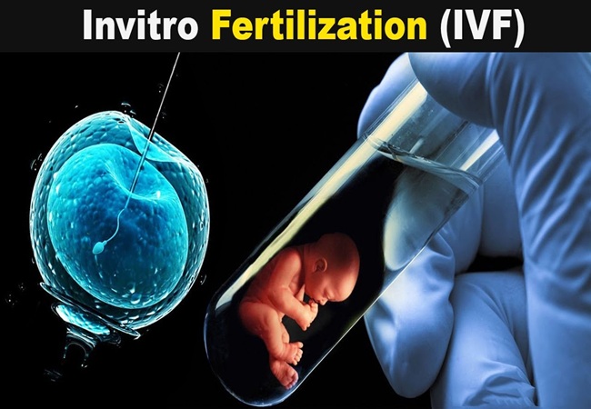 IVF (Test Tube Baby)